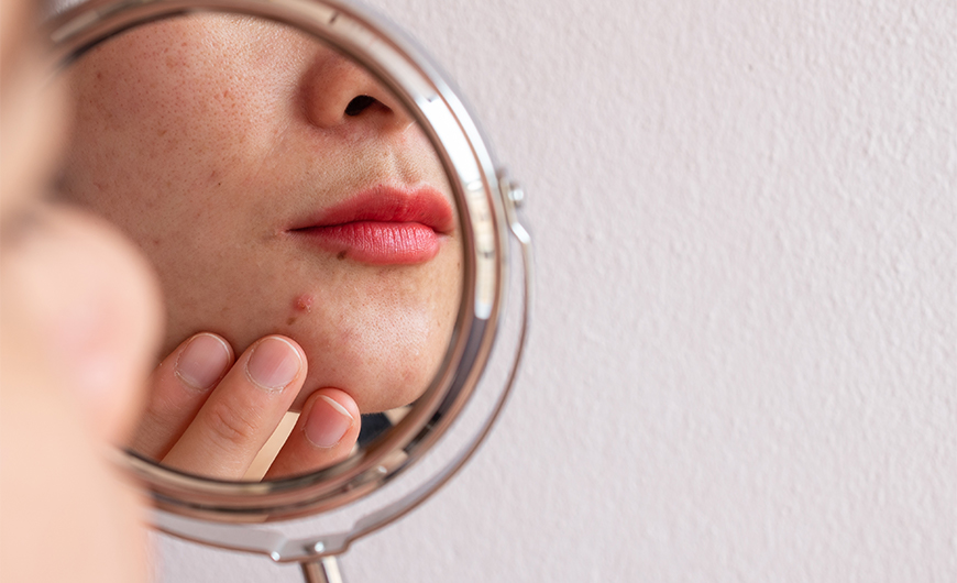 Bőrprobléma ABC – a 7 leggyakoribb bőrprobléma és megoldásaik